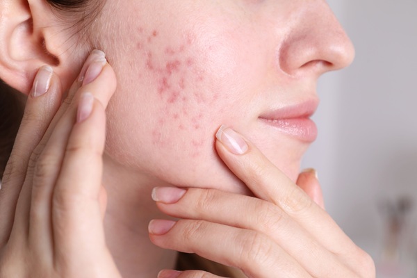 How Medical Acne Treatment Can Improve Skin Health